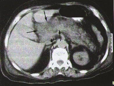 Abdomen agudo médico - Parte 5 Abdomen agudo médico - Parte 5